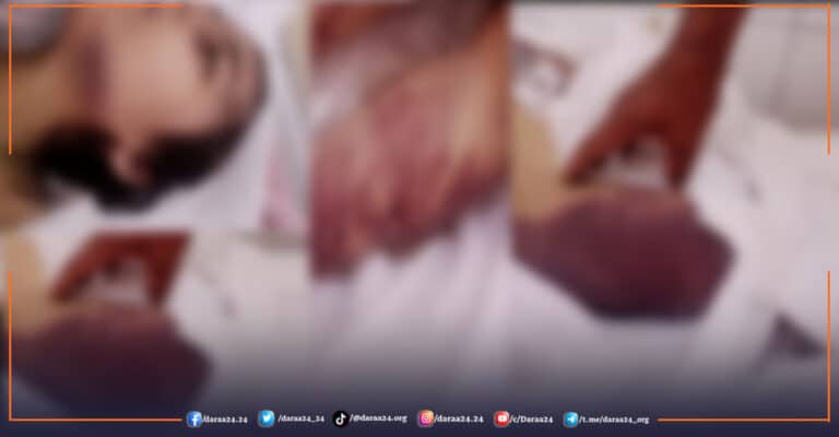 من أثار تعذيب الطفلة فيروز البريقي على يد عمها