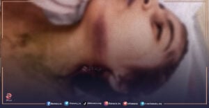العنف ضد المرأة، الصورة من أثار تعذيب الطفلة فيروز البريقي على يد عمها في بلدة المزيريب في الريف الغربي من محافظة درعا