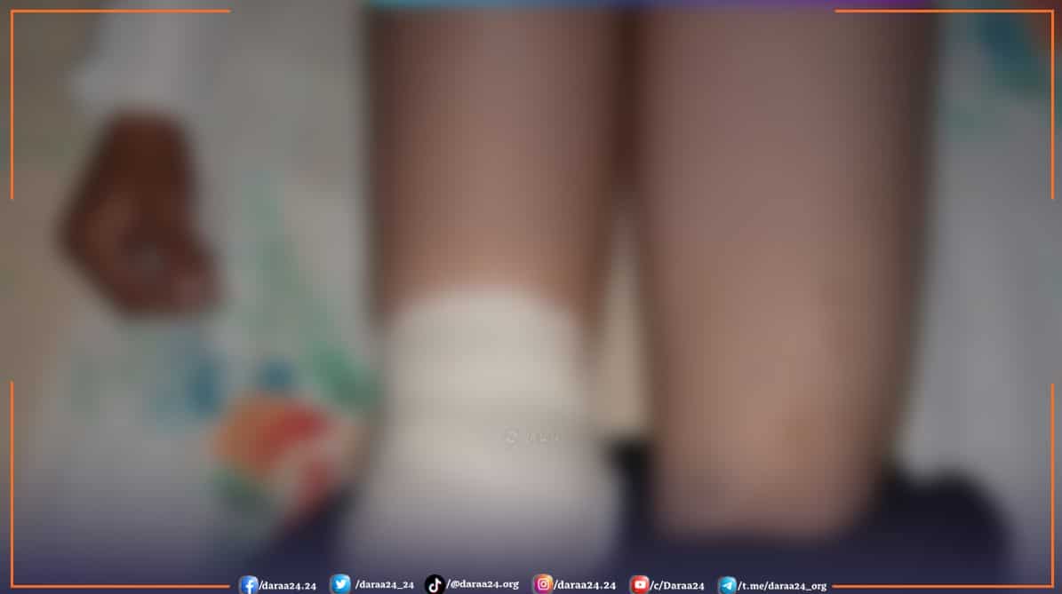 من إصابات الاطفال في الصنمين