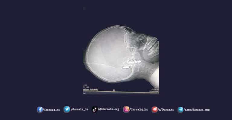 وفاة طفلة من مدينة جاسم متأثرة بإصابتها برصاصة طائشة