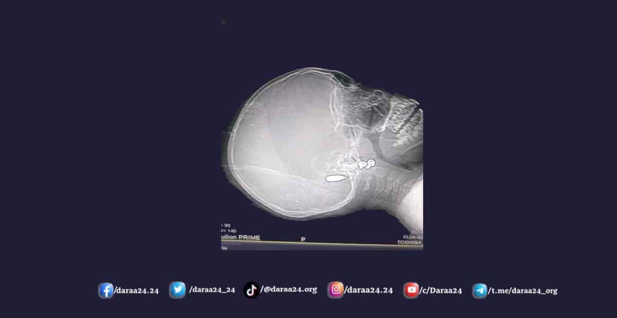 وفاة طفلة من مدينة جاسم متأثرة بإصابتها برصاصة طائشة